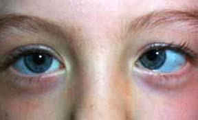 کاردرمانی غرب تهران ، کاردرمانی فلج مغزی